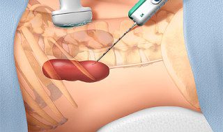 iquid biopsy to detect diseases at an early stage