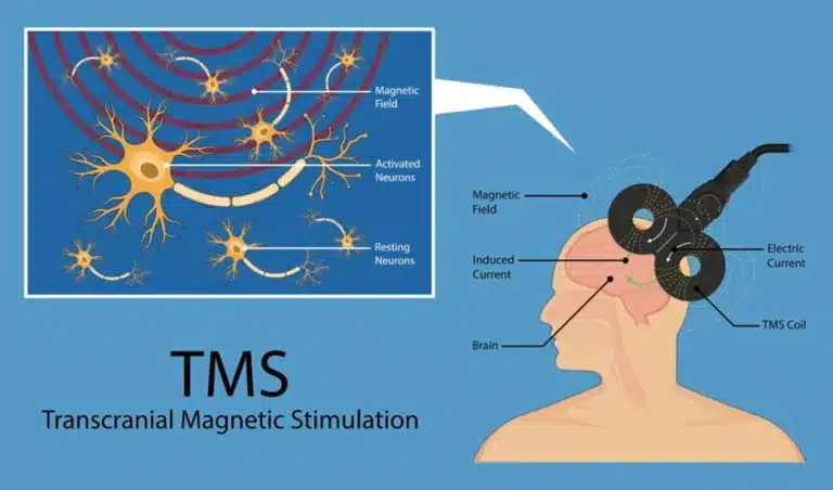 A quick glimpse at how TMS works